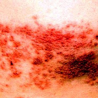 Herpes zoster (shingles): what is it, symptoms, causes and treatment