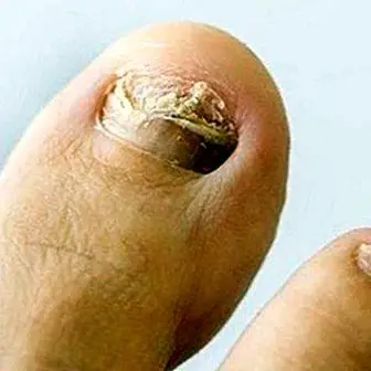 Zakaj se glive pojavljajo na stopalih in kakšni so simptomi