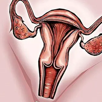 Vaginalna kandidiaza, tiha bolezen, ki potrebuje le nadzor