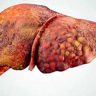 Cirrose hepática: o que é, causas, sintomas, tipos e tratamento
