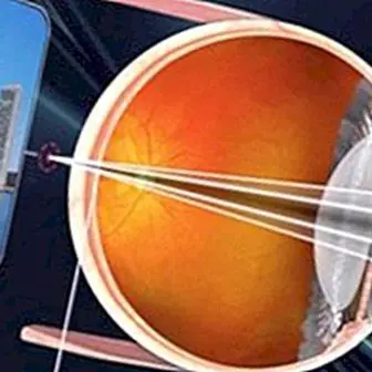 Presbyopia: mis see on, sümptomid, põhjused ja ravi