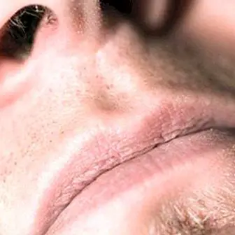 Ninapolüübid (massid või graanulid ninas): mida nad on, sümptomid ja ravi