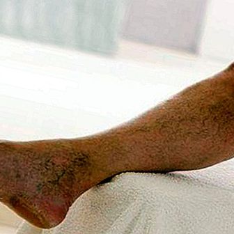 What is phlebitis and thrombophlebitis: symptoms, causes and treatment