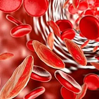 Anemija zaradi pomanjkanja ali pomanjkanja železa (anemija zaradi pomanjkanja železa): vzroki in simptomi
