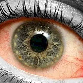 Kenapa detasmen retina berlaku?