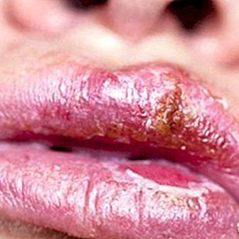 Febbre nel labbro: che cos'è, cause, sintomi e trattamento