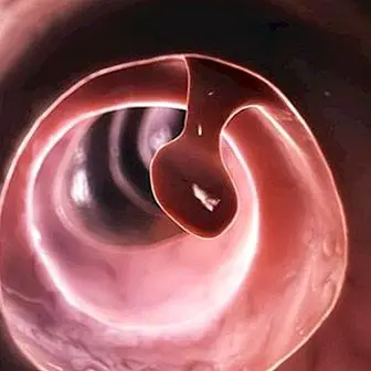 What is a polyp, why it appears and its symptoms