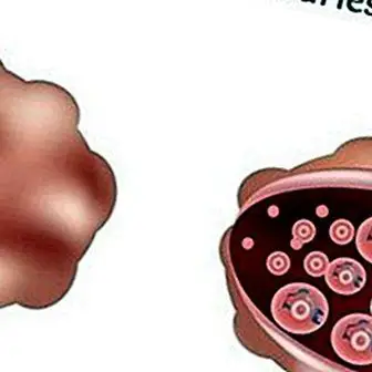 Ovariálna polycystóza: príznaky, príčiny a lekárske ošetrenie