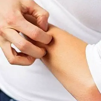 Dermatite atopica: sintomi, cause e trattamento
