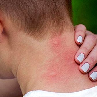 How to cure mosquito bites with these natural remedies