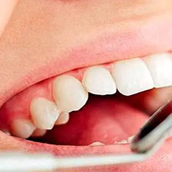 3 domáce metódy, ako sa zbaviť zubného kameňa