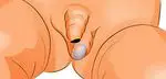 Cryptorchidie: le testicule n'est ni descendu ni caché. Causes, symptômes et comment est-il traité - bébés et enfants