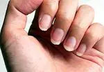 Causes of weak nails and treatments to strengthen them - beauty