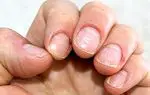 Problemen van de meest voorkomende nagels en hoe deze te beschermen om ze te voorkomen