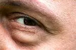 8 tipov a nápravných prostriedkov na zabránenie opuchu očí