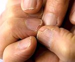 ぜい性およびうろこ状の爪：キュウリの原因と自然療法