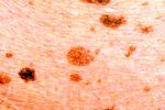 Κηλίδες του δέρματος: αιτίες, προέλευση και θεραπεία