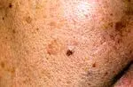What is melasma and why does it appear?