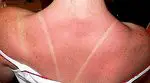 Natural tips to treat sunburn - healthy tips