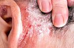 What is psoriasis, symptoms, causes and treatment