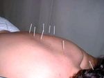 When acupuncture came to the West