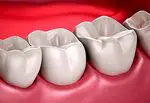 Quais são os dentes do siso usados ​​e por que eles são chamados