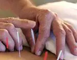 Akupunktúra, účinná pri zmierňovaní bolesti