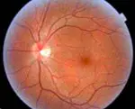 Macular degeneration associated with age: symptoms, causes and treatment