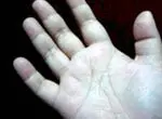 Picotement dans les mains et syndrome du canal carpien - les maladies