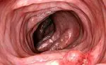 Polyps in the colon are they dangerous? Symptoms and treatment