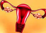 Syndrome des ovaires polykystiques: ce que c'est, les symptômes, les causes et le traitement