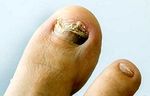 Zakaj se glive pojavljajo na stopalih in kakšni so simptomi - bolezni