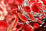 Anemia, joka johtuu raudan puutteesta tai puutteesta (raudan puutos anemia): syyt ja oireet