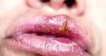 Fever in the lip: what it is, causes, symptoms and treatment