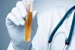 Das Bilirubin im Urin - medizinische Tests