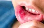 Wie man Wunden im Mund mit natürlichen Mitteln vorbeugen und heilen kann
