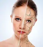 How to improve the cracks in the skin with natural remedies