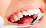 3 domače metode, da se znebite zobnega kamna